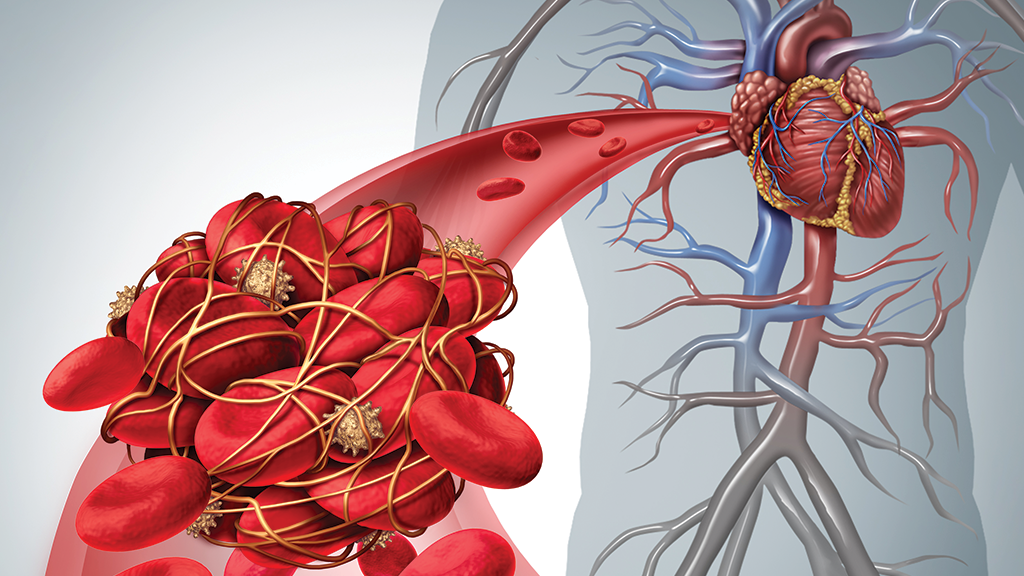 NuvaRing Lawsuit Shiner Law Group, P.A.